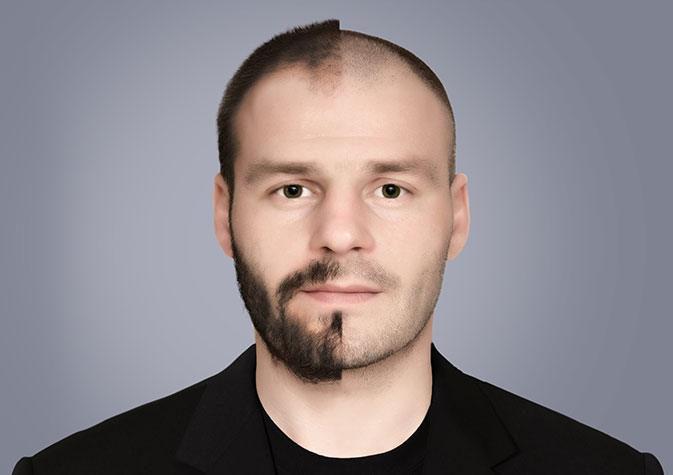 Hair Transplant in vadodara