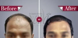 Yuva-hair-transplant-results4