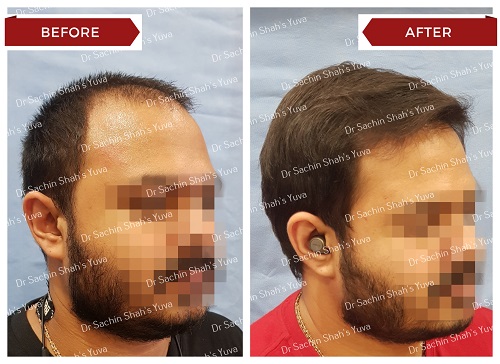 Hair Transplant in Vadodara hair-3